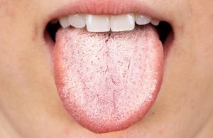 ATTENTION: This could be happening to you if you have a white tongue and…